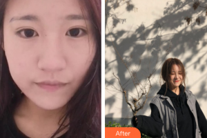 廣州醫(yī)學院第二附屬醫(yī)院整形美容中心肖和整形價格表附無針水光案例展示