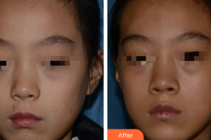 廣州美恩整形美容醫(yī)院朱思蓉整形價格表附激光點痣案例展示