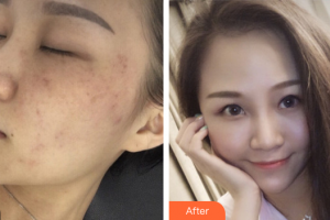 廣州曙光醫(yī)學美容醫(yī)院陳光平整形價格表附祛斑祛痣案例展示