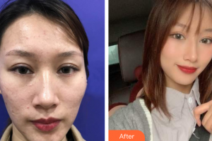 廣州美恩整形美容醫(yī)院王露整形價格表附皮膚管理案例展示