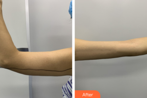 廣州美涵醫(yī)療整形美容醫(yī)院蘇錦和整形價格表附吸脂案例展示