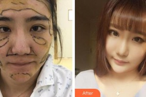 上海復(fù)麗醫(yī)療美容門診部鄭佳瑋整形價格表附自體脂肪案例展示