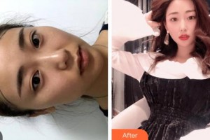 上海WA臻景醫(yī)療美容門診部徐昌勛整形價格表附植發(fā)案例展示