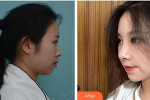 上海宸妃醫(yī)學(xué)美容醫(yī)院王雷整形價(jià)格表附打造精致自然翹鼻案例展示