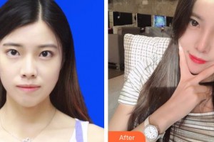 上海伊萊美醫(yī)療美容醫(yī)院邱文苑整形價(jià)格表附肋軟骨隆鼻案例展示