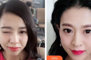 上海達(dá)醫(yī)院醫(yī)療美容科馬秀偉整形價(jià)格表附發(fā)際線種植案例展示