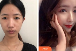 上海美爾雅醫(yī)療美容醫(yī)院張誠(chéng)洙整形價(jià)格表附眼部綜合案例展示