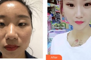 上海美未央醫(yī)療美容門(mén)診部劉堯整形價(jià)格表附牙齒矯正案例展示