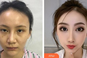 上海鉑曼醫(yī)療美容門(mén)診部楊群整形價(jià)格表附全切雙眼皮案例展示