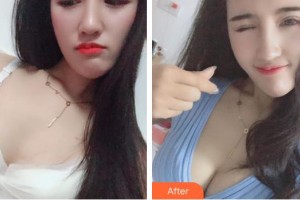 上海明慨醫(yī)療美容門(mén)診部張浩杰整形價(jià)格表附濃縮豐胸真實(shí)案例案例展示