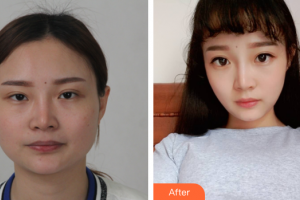 廣州中山醫(yī)博濟醫(yī)院整形美容中心黎葉整形價格表附DA·頜面整形案例展示