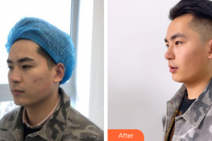 廣州解放軍第四五八醫(yī)院激光整形美容中心鐘衛(wèi)民整形價格表附祛痘印案例展示