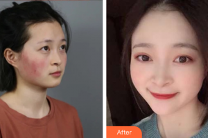 廣州遠東美容醫(yī)院馮潔整形價格表附微針修復(fù)敏感肌案例展示