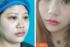 上海明慨醫(yī)療美容門(mén)診部朱士品整形價(jià)格表附面部吸脂案例展示