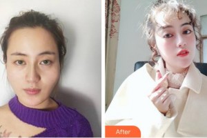 上海明慨醫(yī)療美容門(mén)診部王胡飛整形價(jià)格表附顴骨顴弓整形術(shù)案例展示