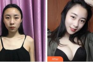 上海明慨醫(yī)療美容門(mén)診部慎孔宇整形價(jià)格表附假體隆胸案例展示