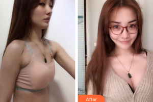 廣州星團醫(yī)學(xué)美容門診部祖秉毅整形價格表附濃縮豐胸案例展示