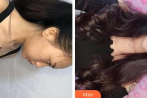 上海明慨醫(yī)療美容門(mén)診部陳建君整形價(jià)格表附果酸煥膚案例展示