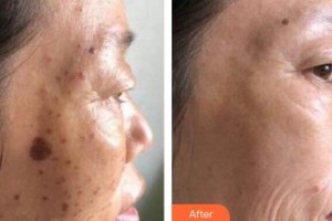 上海明慨醫(yī)療美容門(mén)診部田甜整形價(jià)格表附激光美膚激光祛斑案例展示