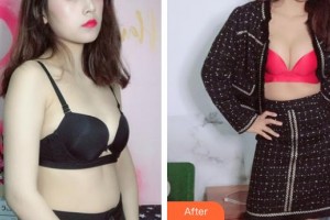 上海明慨醫(yī)療美容門(mén)診部王亮整形價(jià)格表附濃縮豐胸真實(shí)案例展示