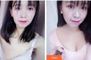 上海亞柏醫(yī)療美容診所童新輝整形價(jià)格表附濃縮豐胸真實(shí)案例展示