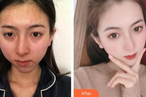 上海伊美爾港華醫(yī)療美容醫(yī)院劉坤整形價(jià)格表附鼻部手術(shù)案例展示