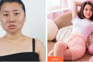 醫(yī)療美容門(mén)診部白承燦整形價(jià)格表附濃縮豐胸真實(shí)案例展示