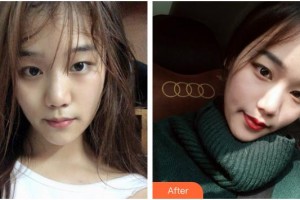 上海芙艾醫(yī)療美容門(mén)診部張桂蓉整形價(jià)格表附光子嫩膚案例展示