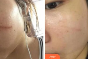 醫(yī)療美容門(mén)診部丁曉東整形價(jià)格表附祛疤案例展示