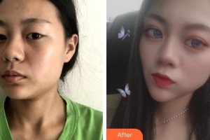 醫(yī)療美容門(mén)診部何祥龍整形價(jià)格表附洛麗塔美眼案例展示