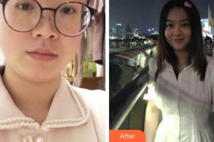 上海鄭逸冰醫(yī)療美容醫(yī)院王秋蓮整形價(jià)格表附溶脂案例展示