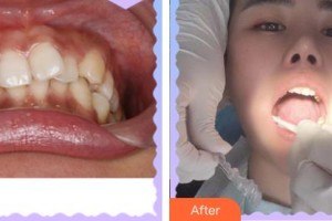 上海百達(dá)麗醫(yī)療美容醫(yī)院徐悠游整形價(jià)格表附隱形托槽矯正案例展示