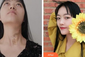 上海百達(dá)麗醫(yī)療美容醫(yī)院陳立彬整形價(jià)格表附燙傷疤痕修復(fù)案例展示