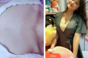 上海時(shí)光整形外科醫(yī)院邱曉玲整形價(jià)格表附隆胸案例展示