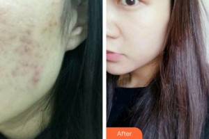 上海美立方整形醫(yī)院王娟整形價(jià)格表附微針激光清痘案例展示