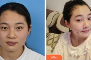 上海美立方整形醫(yī)院迪娃整形價(jià)格表附光子嫩膚案例展示