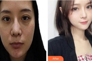 上海東方麗人美容醫(yī)療醫(yī)院曾廣華整形價(jià)格表附面部填充案例展示