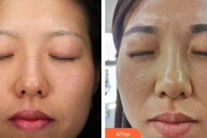 上海鵬愛醫(yī)療美容門診部樊學(xué)慧整形價(jià)格表附光子嫩膚案例展示