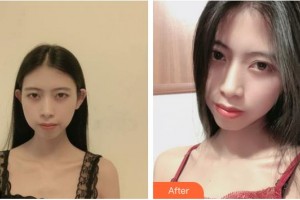 上海宸妃醫(yī)學(xué)美容醫(yī)院宋蔚整形價(jià)格表附微針美白嫩膚縮小毛孔案例展示