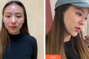 廣州星團醫(yī)學(xué)美容門診部田夫整形價格表附自體肋軟骨隆鼻案例展示