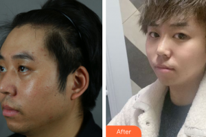 廣州星團醫(yī)學(xué)美容門診部劉歡整形價格表附下頜角+皮質(zhì)骨+夾脂墊案例展示