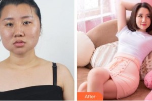宜昌華美美星整形美容醫(yī)院屈平安整形價格表附濃縮脂肪豐胸案例展示