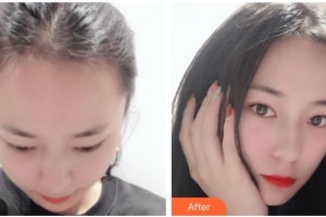 上海曙康口腔門診部康鈞棠整形價(jià)格表附發(fā)際線種植案例展示