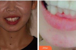 上海齊美口腔門診部方明浩整形價(jià)格表附超聲波潔牙案例展示