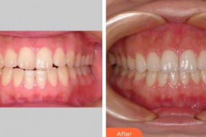 上海齊美口腔門診部朱金山整形價(jià)格表附牙齒隱形矯正案例展示