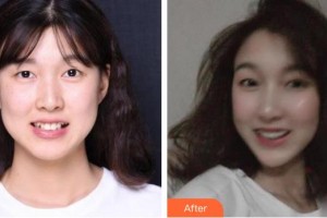 上海科瓦口腔門診部季愛萍整形價(jià)格表附隱形托槽矯正案例展示