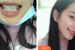 上海雅圣口腔門診部洪允義整形價(jià)格表附超聲波潔牙案例展示