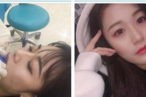 上海市口腔醫(yī)院包向軍整形價(jià)格表附全隱形牙齒矯正案例展示