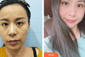 上海明潭眼科門診部王素羽整形價(jià)格表附眼部手術(shù)案例展示