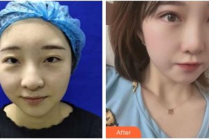 上海明潭眼科門診部趙竑彥整形價(jià)格表附眼部整形案例展示